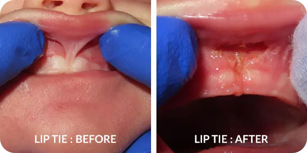 Infant Tongue & Lip Ties - Center for Airway and Facial Development